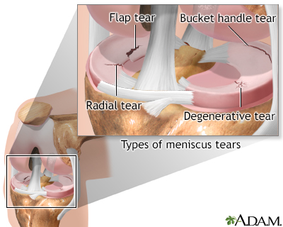 Meniscal tears - illustration