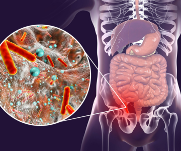 Appendicitis